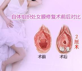 处女膜修复手术有风险吗？韩式处女膜修复是什么？处女膜图解