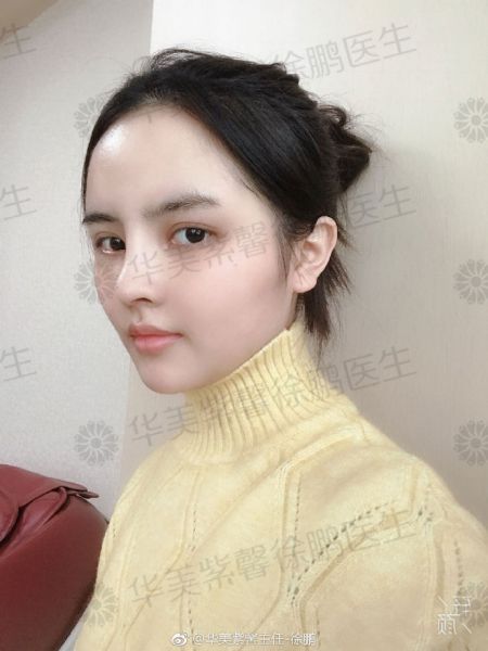 华美紫馨—肋软骨隆鼻有什么后遗症？