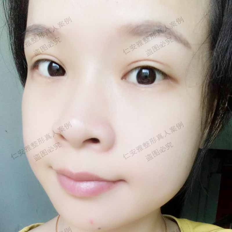 深圳割双眼皮专家有哪些?刘月更和苗春来哪位医生更厉害? 深圳割双眼皮专家有哪些?刘月更和苗春来哪位医生更厉害?