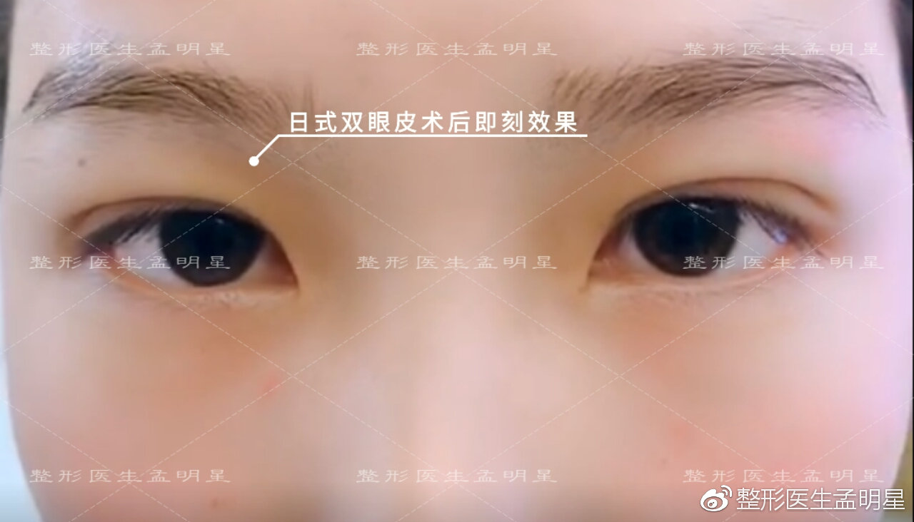 孟明星医生的日式无痕双眼皮是不是埋线双眼皮？