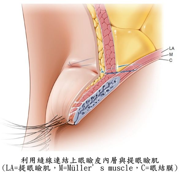 眼整形解密（五）：双眼皮手术的方式有哪些? 双眼皮可能的并发症有哪些？