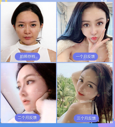 上海伊莱美钱玉鑫、邱文苑哪个做肋骨鼻综合隆鼻更好？