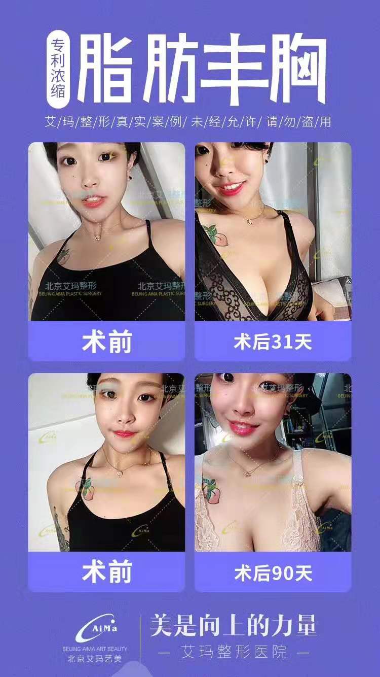 北京艾玛脂肪丰胸多少钱，韦元强脂肪丰胸怎么样？