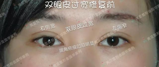 中国最好的眼修复知名专家推荐：金国华（案例预约价格）双眼皮修复怎么样？