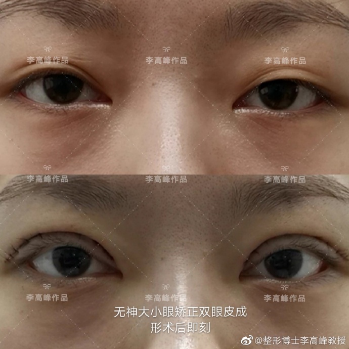 湖南省人民医院李高峰做双眼皮好看吗? 湖南省人民医院李高峰做双眼皮好看吗?