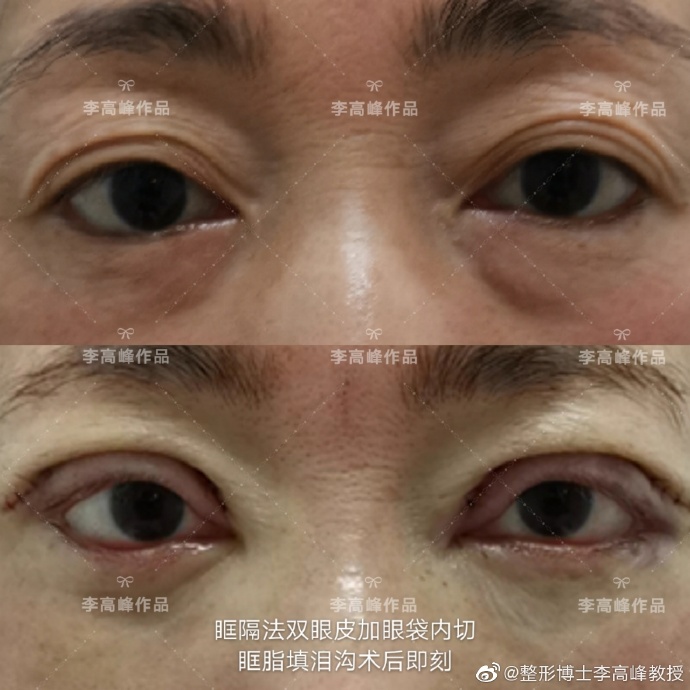 湖南省人民医院李高峰做双眼皮好看吗? 湖南省人民医院李高峰做双眼皮好看吗?