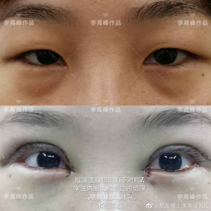 湖南省人民医院李高峰做双眼皮好看吗? 湖南省人民医院李高峰做双眼皮好看吗?
