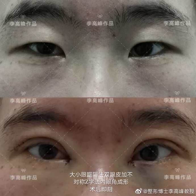 湖南省人民医院李高峰做双眼皮好看吗? 湖南省人民医院李高峰做双眼皮好看吗?