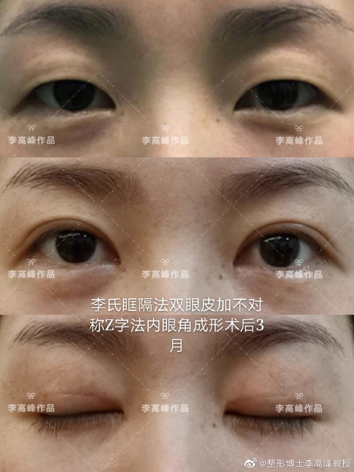 湖南省人民医院李高峰做双眼皮好看吗? 湖南省人民医院李高峰做双眼皮好看吗?