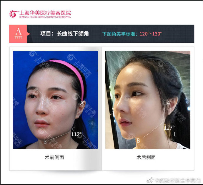 上海首尔丽格崔荣达华美李志海时光何晋龙伊莱美李湘原哪家磨骨好？