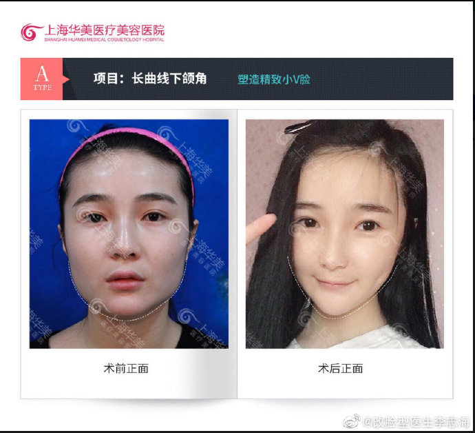 上海首尔丽格崔荣达华美李志海时光何晋龙伊莱美李湘原哪家磨骨好？