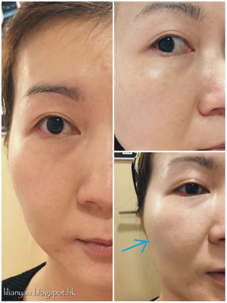 什么是Derma Vei第二代l童颜针？Derm a Veil童颜针有什么特点？