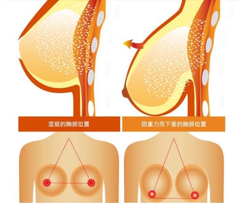 乳房下垂有哪几种手术改善方式？轻度中度重度乳房下垂矫正