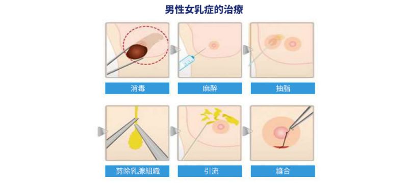 男性女乳症有哪些手术方式可以解决？乳腺切除乳房抽脂