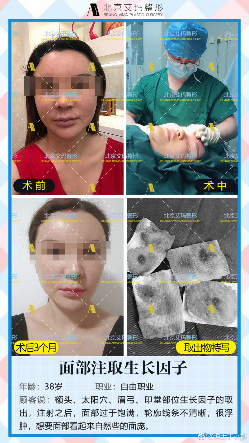 北京取不明注射物(生长因子取出奥美定取出)专家都有哪些？丁小邦李奇军李方奇