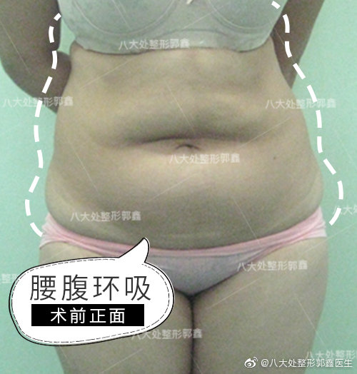 八大处最好的脂肪填充专家：王淑杰、李发成、顾云鹏哪个最好？