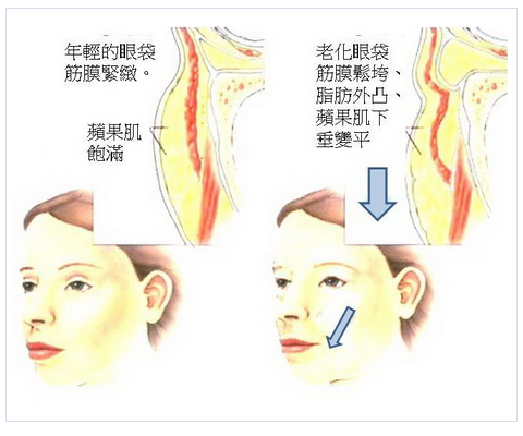 初级的眼袋注射肉毒素 再老化的眼袋必须要注射玻尿酸吗？