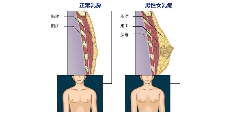 何时为男性女乳症的好发期？如何判断男性女乳症？