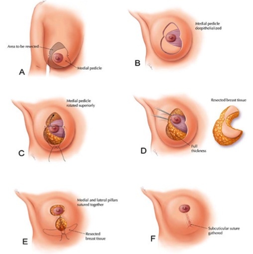 胸部过大童颜巨乳怎么办？棒棒糖式短疤缩乳术（缩胸）