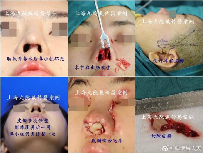 上海九院隆鼻修复专家哪个最好？戴传昌陈付国李圣利王涛鼻修复谁厉害？