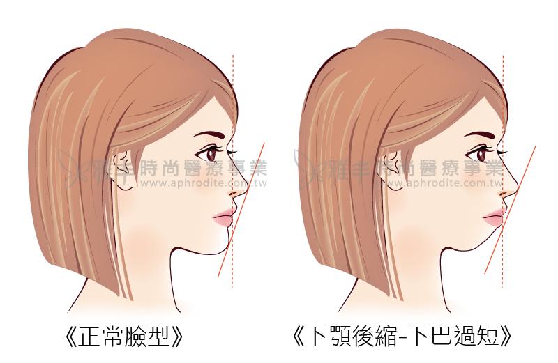 下颚太长怎么办？正颚手术原始条件和设计理念