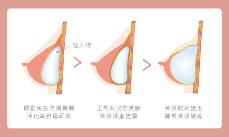 荚膜挛缩(Capsular Contracture)是什么？什么是内视镜隆胸？