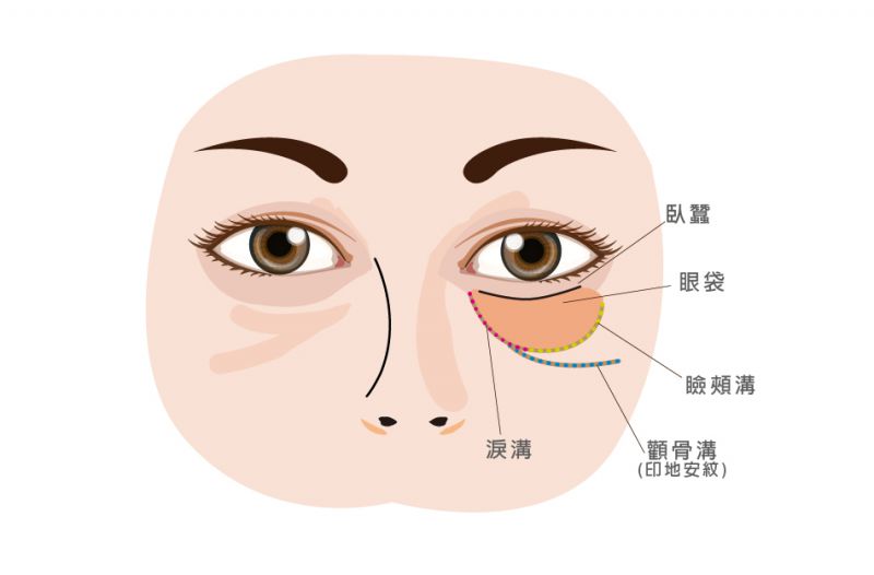 评美帮教你一招分辨什么是卧蚕、眼袋、泪沟？