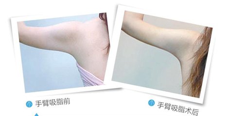 男性抽脂和女性抽脂有什么不同？男性抽脂后不会脂肪流失凹凸不平吗？