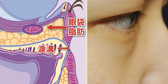 眼袋让人老  为什么会有眼袋?评美帮带你了解眼袋形成的原因