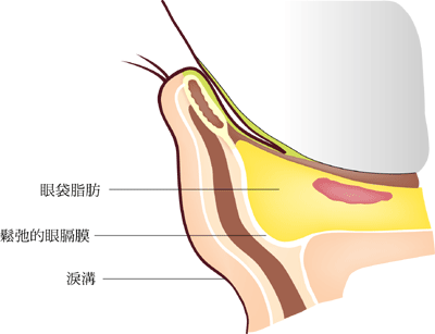 什么是下眼袋？单纯的抽眼袋手术能解决下眼袋吗？