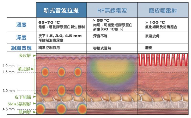 音波拉提（拉皮）的作用原理是什么？有哪些优点？