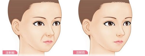 自体脂肪填充移植和玻尿酸填充以及微晶瓷注射全方位对比