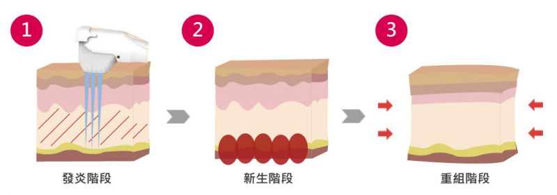 音波拉皮作用机转是怎样的？音波拉提拉皮术前术后注意事项有哪些？