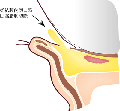 眼袋成因和严重程度不一样手术方式一样吗？去眼袋手术方式大全