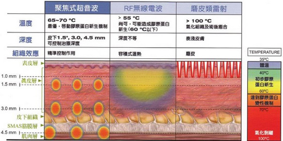 音波拉提会痛吗?有任何的副作用吗?禁忌症?