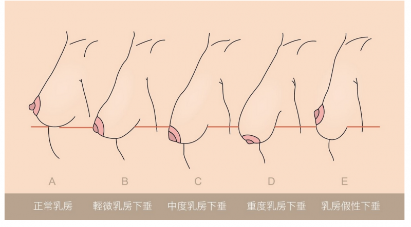 胸部下垂还有得救吗？怎么判断自己的乳房是不是下垂？