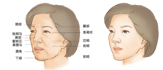 自体脂肪填充一般取哪些部位的脂肪？移植填充后多长时间才会稳定？