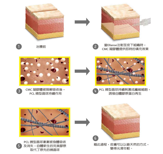 依恋诗疗程作用机制是什么？立即填充有效拉提持续刺激胶原蛋白增生