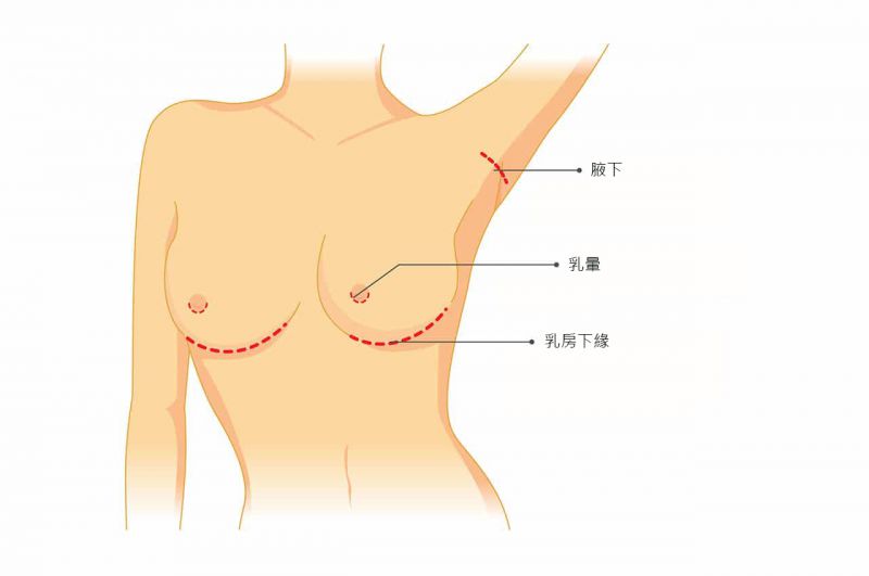 内视镜脂感水滴隆胸手术切口在哪里？