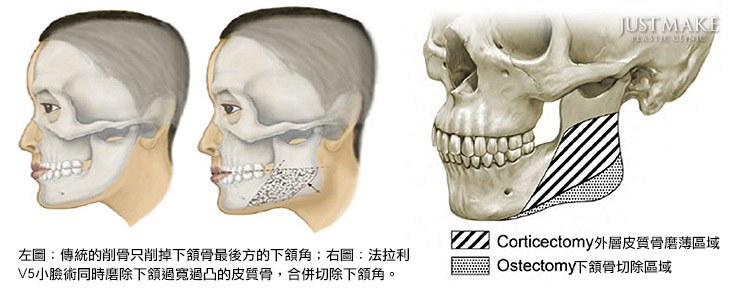 削骨磨骨术后注意事项有哪些？磨骨削骨手术后多少天消肿恢复期？