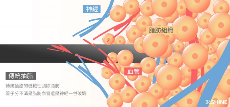 传统抽脂和震动式抽脂哪个效果抽脂瘦身效果更好？