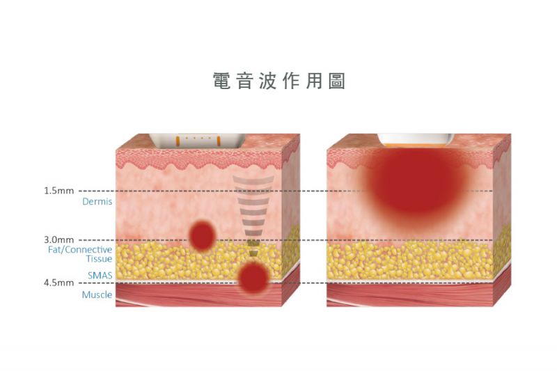 Ultracel电音双波治疗过程需要多久？痛吗？Ultracel电音双波副作用？