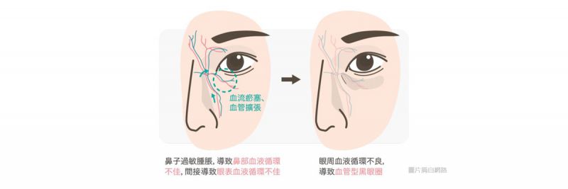 黑眼圈有哪些美容疗程？湿敷与冷热敷果酸换肤美白导入黑眼圈效果好吗？