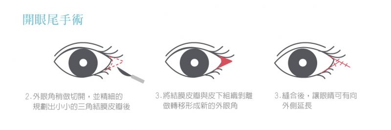 开外眼角手术方式是什么？眼尾下至的原因是什么？