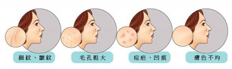 飞梭雷射分段式原理是什么？痘疤、毛孔粗大用飞梭镭射效果怎么样？