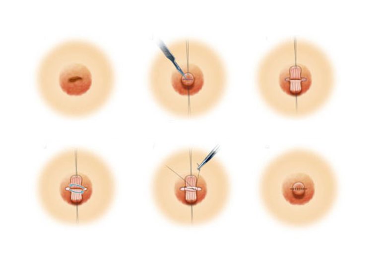 美胸部不可忽略的关键：乳头乳晕改造术乳头凹陷矫正术简介