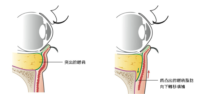 眼袋脂肪可以转移到泪沟凹陷处填充泪沟吗？眼袋转移术