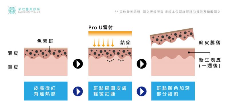 PRO U透白机美白除斑755nm雷射波长对黑色素效果怎么样？