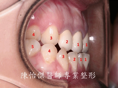 咬合不正对嘴形以及笑容的影响(第三型咬合不良、戽斗、牙龈外露)有哪些？