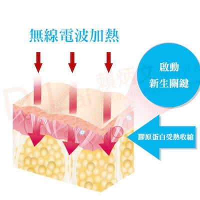 脸部年轻化电波拉皮的原理和效果怎么样？